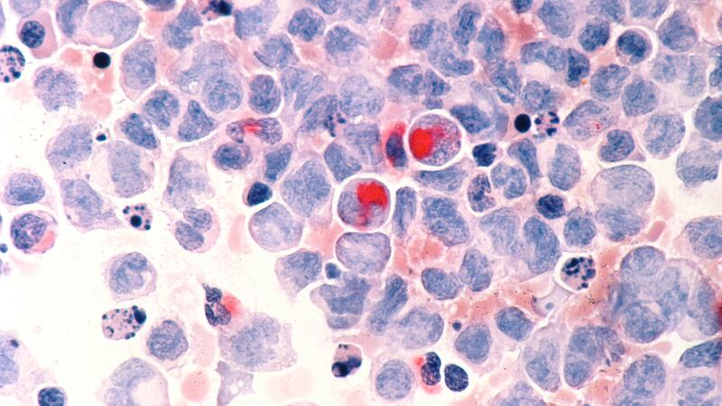 This March 1988 microscope photo provided by the National Cancer Institute shows human cells...
